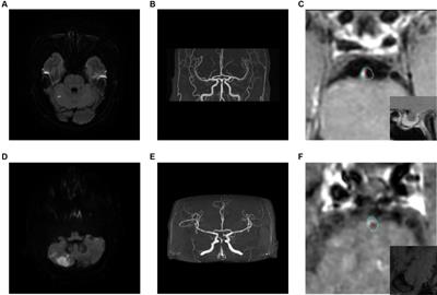 HR-MRI-based nomogram network calculator to predict stroke recurrence in high-risk non-disabling ischemic cerebrovascular events patients